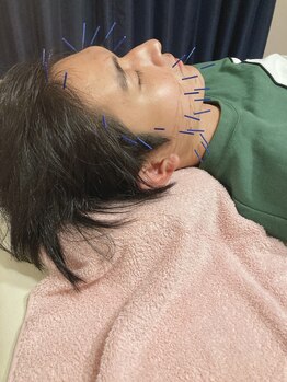 キヅキ鍼灸整体スタジオ(KIZUKI鍼灸整体スタジオ)/美容鍼 男性もオススメ♪