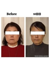 ミラクル(Miracle)/５０代にも効果的な小顔