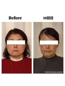 ミラクル(Miracle)/50代にも効果的な小顔