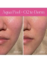 ハナイロ(hana-iro)/脂性肌改善