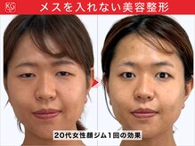 顔ジム 麻布店/20代女性顔ジム1回の効果
