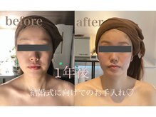 ラ フルール(La Fleur)/小顔矯正コルギ　before→after