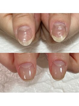 セラキュアネイル(Theracure nail)/凹凸がある爪も健康な爪に育む