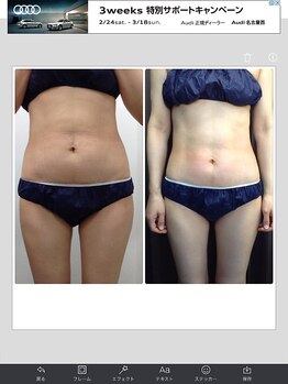 健康痩身研究所 蟹江店/ビフォーアフター