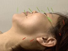やさしい鍼灸