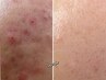 【ベタつき肌を肌質改善】剥離なしハーブピーリング