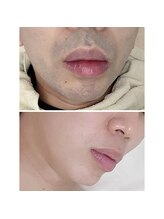 ユニクリア(Uni clear)/ヒゲ脱毛