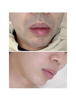 ユニクリア(Uni clear)/ヒゲ脱毛