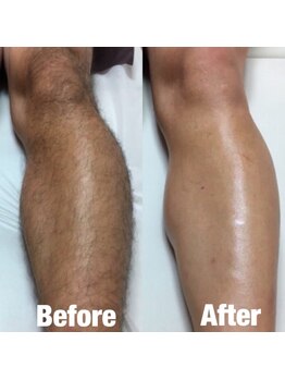 メンズ脱毛サロンBOSS 犬山店/【メンズ脱毛/足脱毛】