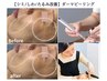 【シミ/しわ/たるみ改善】ダーマピーリング+高濃度美容液導入で若見え肌に★