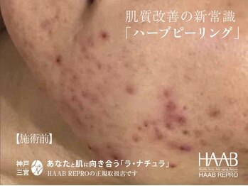 ラ ナチュラ(La natura)/HAAAREPRO(ハーブピーリング)