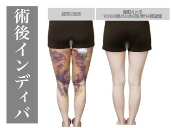 エステサロン ヴリエ 立川店/あざも硬さも緩和★回復力向上