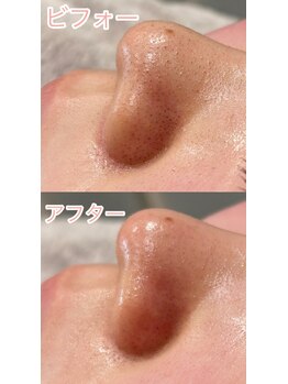 シュエット(Chouette)/韓国式3D毛穴洗浄 1回