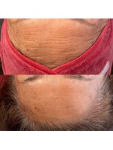 ソワン ボーテ(Soin Beaute)/ハーブピーリングの効果です