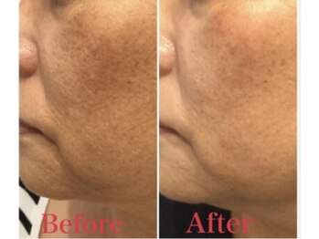 サロン リュンヌ(salon lune)/ハーブピーリング