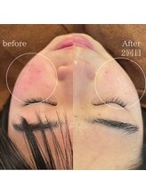 アンノウン(Unknown.)/韓国美肌　無針水光注入　毛穴