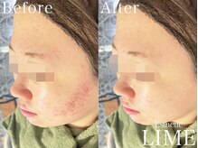 ライム 池袋東口(LIME)/ハーブピーリング｜ニキビケア