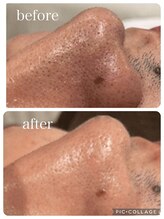 ランソ ビューティー 成田(RUNSO Beauty)/ハイドラ毛穴洗浄でいちご鼻解決