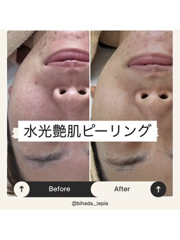 レピア(Le'pia)/水光艶肌ピーリング