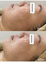 ムム(mumu)/シミシワ・リフトアップ