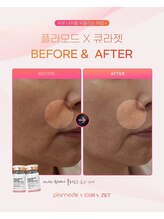 ミロク(369)/リジュラン成分ジェット注入