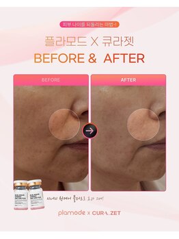 ミロク(369)/リジュラン成分ジェット注入