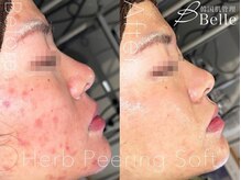 ベル 静岡(Belle)/静岡/ハーブピーリング/毛穴