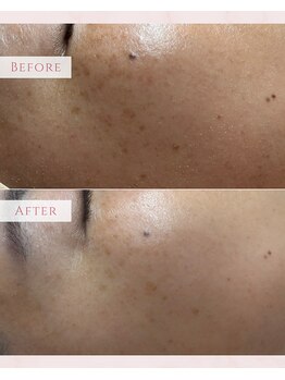 コルザフラワー(charroux flower)/シミケア