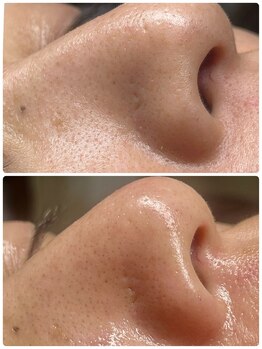 ポマイカイ 名古屋丸の内店(pomaikai)/ハイドロフェイシャル