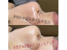 ソワ 吉塚店(soi)の雰囲気（皮脂の詰まりはトラブルに！汚れが落ちれば変わります♪）