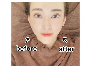 プレッシュ(Presh)/【小顔矯正】