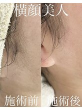 毛穴塾/無添加フェイシャルWAX脱毛