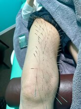 高宮レディース鍼灸整骨院/ルート鍼