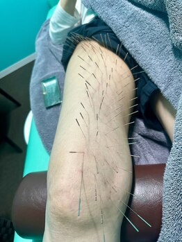 高宮レディース鍼灸整骨院/ルート鍼