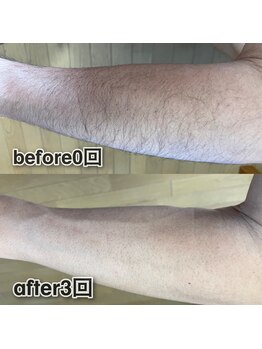 ボウイズ 磐田店(BOYZ)/腕脱毛3回　before after
