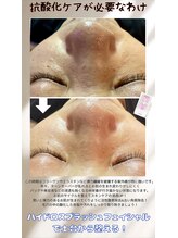 ラブニール 横浜店/ハイドロスプラッシュ(毛穴洗浄)