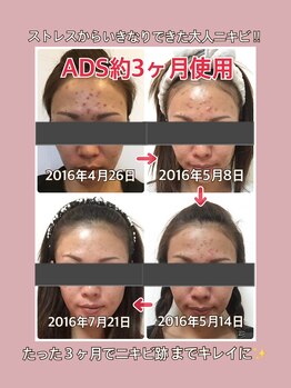 プティ カシェット 伊丹店(petit cachette)/ADS肌質改善ビフォーアフター3★