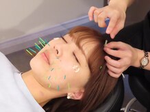 ビゴー鍼灸院 円山院(bigo鍼灸院)の雰囲気（鍼とお灸で深部まで本気の肌質改善！電気鍼はリフトアップ効果UP）