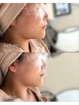 アルフォービューティー 難波店(ALU for beauty)/オンダリフト症例