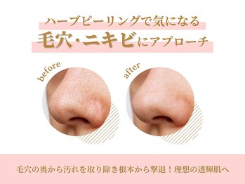 パーフェクトフェイスビューティー 難波店(PERFECT FACE BEAUTY)/ハーブピーリングでアプローチ