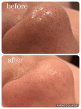 ランソ ビューティー 成田(RUNSO Beauty)/ハイドラフェイシャル