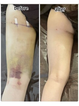 インディバジェム(GEM)/ビフォーアフター