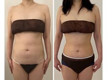 美人バスト 町田店/バストアップ◇症例◇