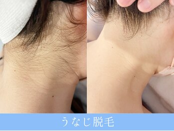 オーシャンブルー 長崎店(OCEAN BLUE)/結果が出る脱毛!うなじ脱毛