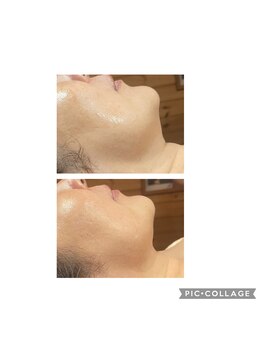 フリージア(Beauty Salon Freesia )/小顔造形×脂肪分解リフト 1回