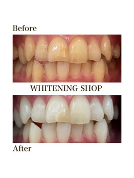 whitening shop 守谷店/ホワイトニングショップ守谷店