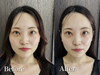 フラット(flat)の写真/美容鍼初めての方にもオススメ!小顔美容鍼で30分で即効リフトアップ¥4980~