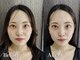 フラット(flat)の写真/美容鍼初めての方にもオススメ!小顔美容鍼で30分で即効リフトアップ¥4980~