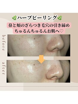 アノネ(Anone.)/ハーブピーリングBefore After