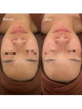 ラピスビューティーサロン(Lapis beauty salon)/肌トラブル・肌質改善☆